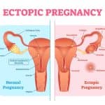 Pregnancy after ectopic medical diagram showing normal vs ectopic pregnancy in female reproductive system