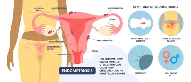 Illustration showing endometriosis symptoms and their impact on endometriosis fertility