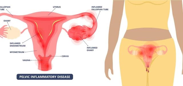 PID symptoms illustration showing pelvic inflammatory disease affecting uterus, ovaries, and fallopian tubes
