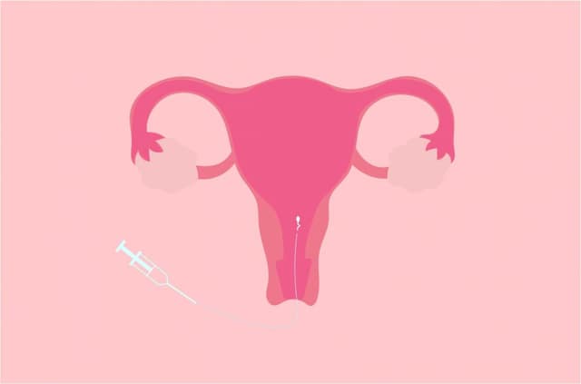 Intrauterine insemination (IUI) illustration showing sperm being placed directly into the uterus using a catheter