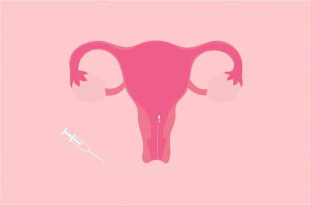 Intrauterine insemination (IUI) illustration showing sperm being placed directly into the uterus using a catheter