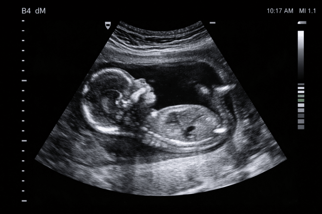 Pregnancy ultrasound showing fetus development in womb during prenatal scan