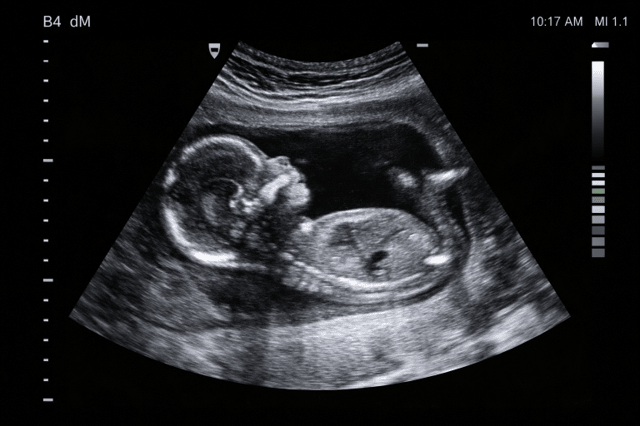 Pregnancy ultrasound showing fetus development in womb during prenatal scan