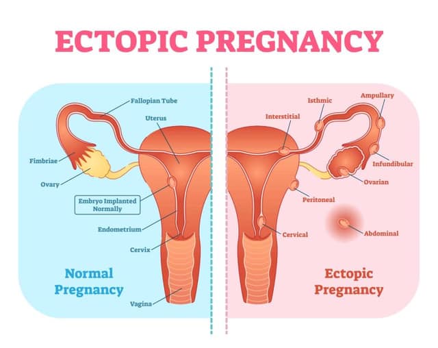 Pregnancy after ectopic medical diagram showing normal vs ectopic pregnancy in female reproductive system