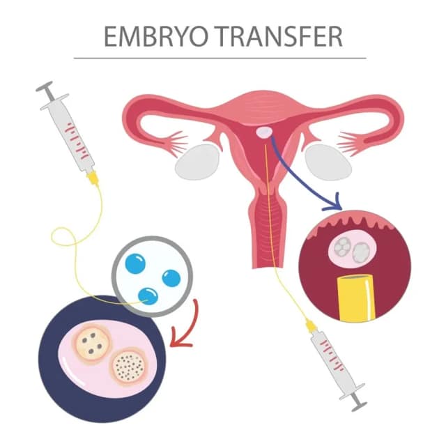embryo donation process with embryo transfer into uterus medical illustration