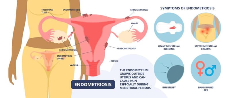 Diagram comparing adenomyosis vs endometriosis and where each condition affects the uterus