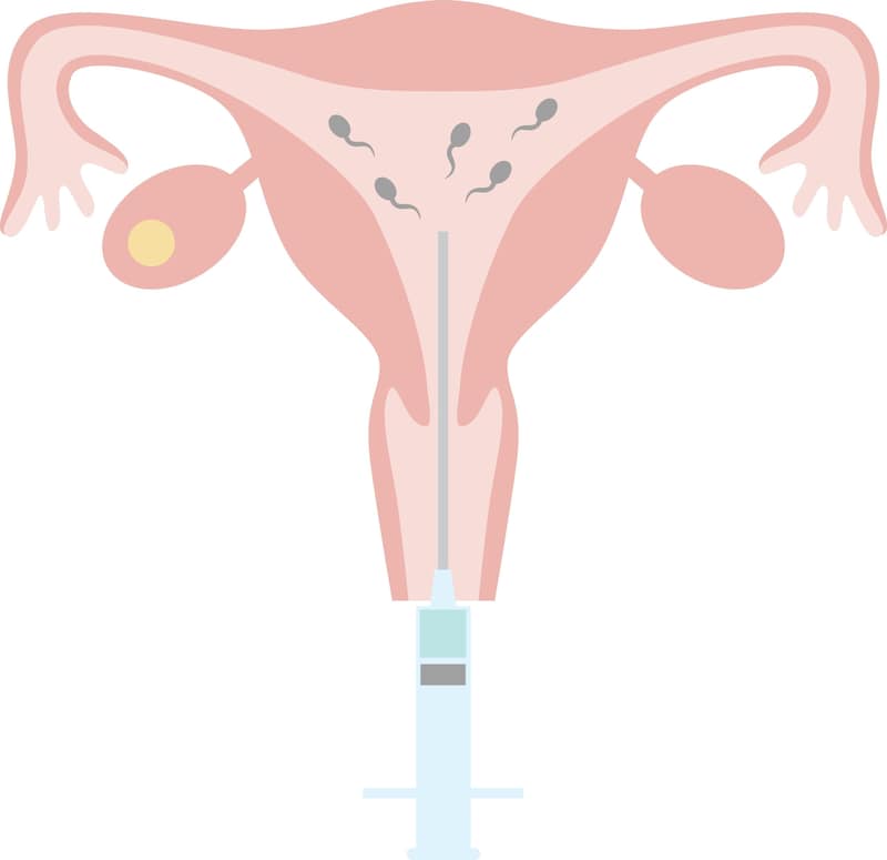 syringe that introduces sperm into a vagina