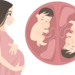 IVF multiple pregnancies : Pregnant woman expecting twins illustration babies in womb