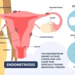 Illustration showing endometriosis symptoms and their impact on endometriosis fertility